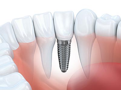 3d-dental-implant