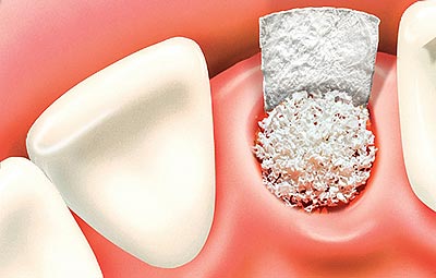 dental-bone-graft