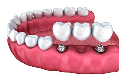 dental-implant-bridge
