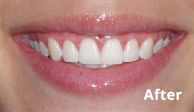 esthetic-crown-lengthening-after