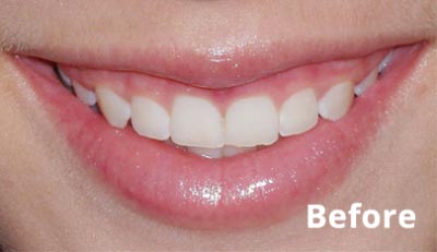 esthetic-crown-lengthening-before