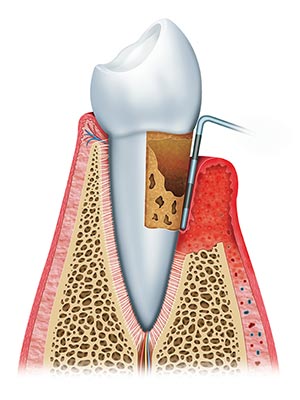 gingivitis