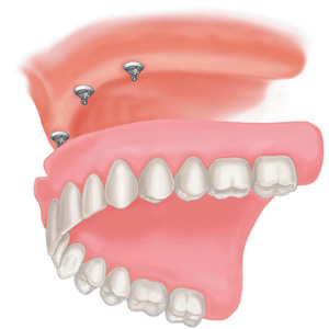implant-full-upper-denture