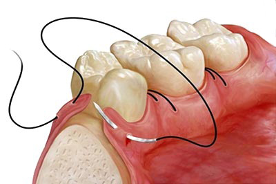 osseous