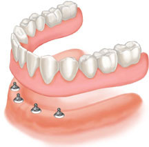 overdenture