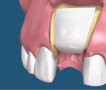 ridge-augmentation2