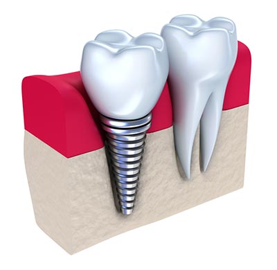 single-tooth-dental-implant
