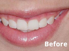 Esthetic Crown Lengthening