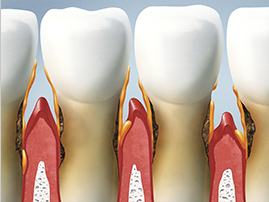 Periodontal Disease