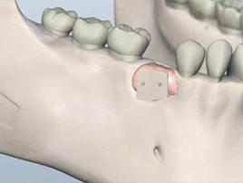 Bone Grafting