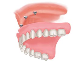 Implant-Supported Dentures