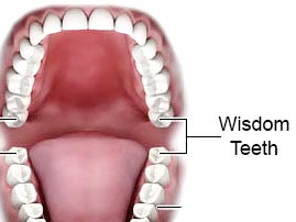 Wisdom Teeth Extractions