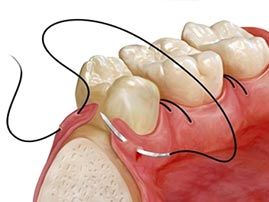 Osseous Dental Surgery