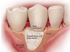 Regenerative Dental Surgery