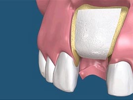 Ridge Augmentation