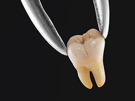 Single Tooth Extraction